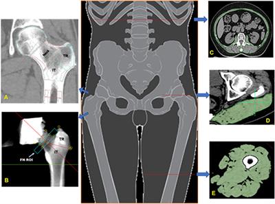 Associations of Muscle Size and Density With Proximal Femur Bone in a Community Dwelling Older Population